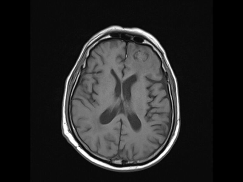 File:Brain metastases from renal cell carcinoma (Radiopaedia 42222-45297 Axial T1 15).jpg