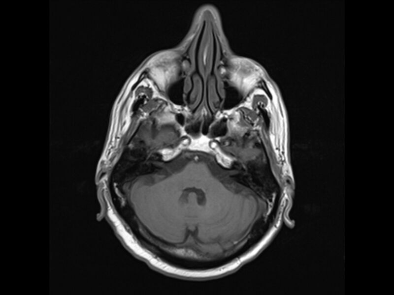 File:Brain metastases from renal cell carcinoma (Radiopaedia 42222-45297 Axial T1 7).jpg