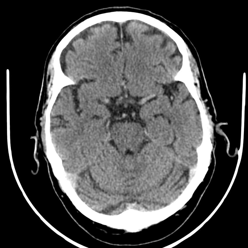 Brain metastasis (Radiopaedia 42617-45760 Axial non-contrast 15).jpg