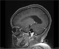 Brainstem glioma (Radiopaedia 21819-21775 D 30).jpg