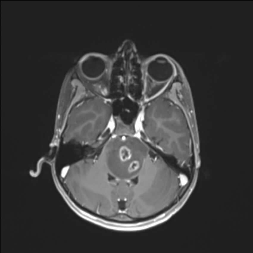 Brainstem glioma (Radiopaedia 70548-80674 Axial T1 C+ 47).jpg
