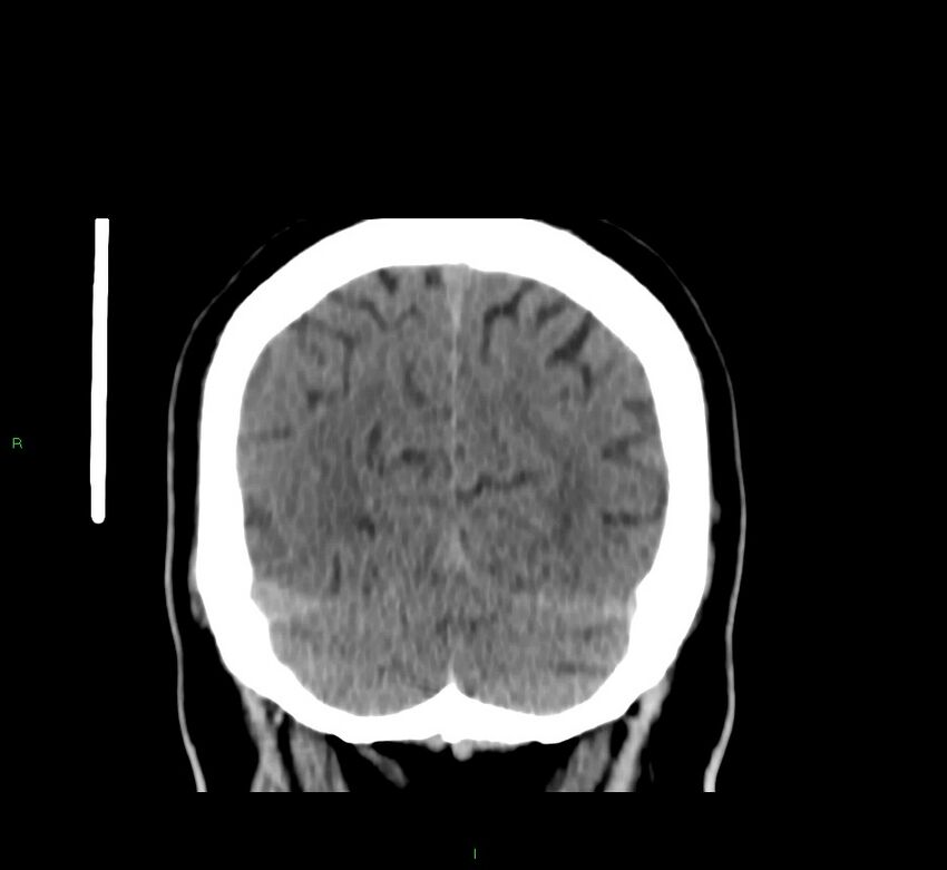Brainstem hemorrhage (Radiopaedia 58794-66028 Coronal non-contrast 15).jpg
