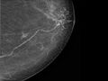 Breast cancer - spiculated mass occult on ultrasound (Radiopaedia 62220-70499 CC 1).jpeg