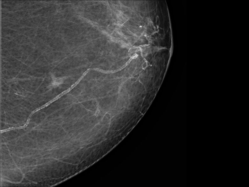 File:Breast cancer - spiculated mass occult on ultrasound (Radiopaedia 62220-70499 CC 1).jpeg