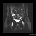 Broad ligament fibroid (Radiopaedia 49135-54241 Coronal STIR 8).jpg