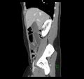 Broad ligament hernia (Radiopaedia 63260-71832 C 17).jpg