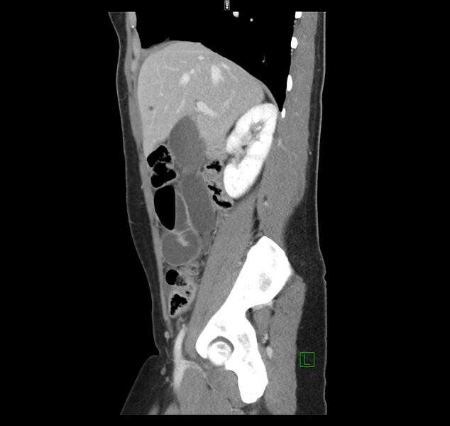 File:Broad ligament hernia (Radiopaedia 63260-71832 C 17).jpg