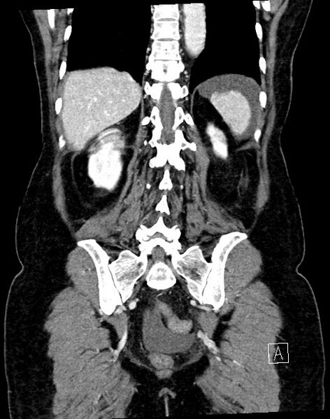 File:Broad ligament hernia (Radiopaedia 84802-100276 B 12).jpg