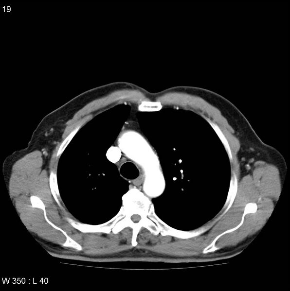 File:Bronchial carcinoid tumor with right lower lobe collapse (Radiopaedia 29060-29422 A 18).jpg