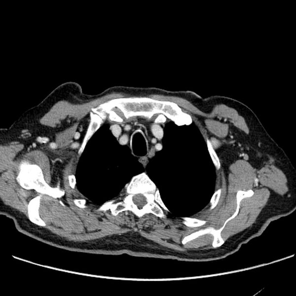 File:Bronchogenic carcinoma with L1 vertebra metastasis (Radiopaedia 9096-9805 Axial C+ delayed 3).jpg