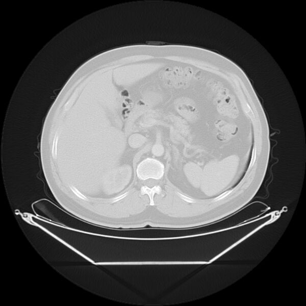 File:Bronchogenic carcinoma with upper lobe collapse (Radiopaedia 29297-29726 Axial lung window 33).jpg