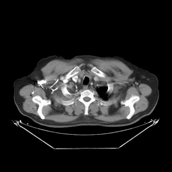 File:Bronchogenic carcinoma with upper lobe collapse (Radiopaedia 29297-29726 C 5).jpg