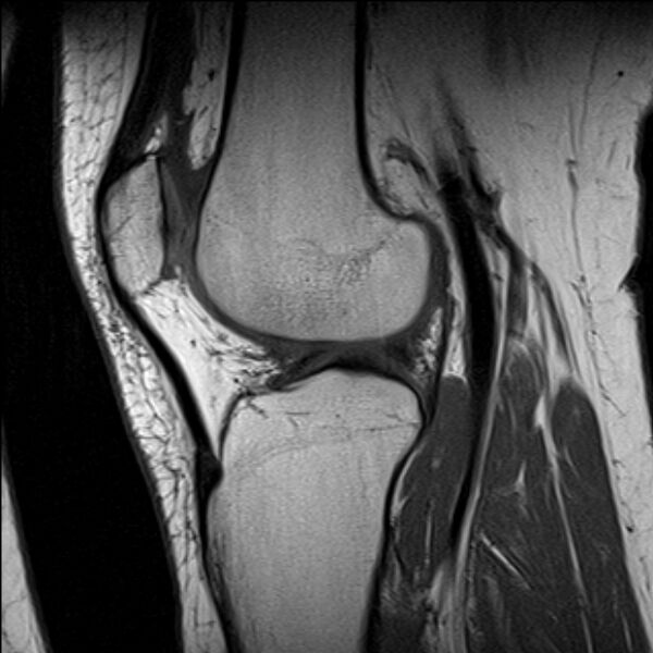 File:Bucket handle tear - medial meniscus (Radiopaedia 79028-91942 Sagittal T1 9).jpg