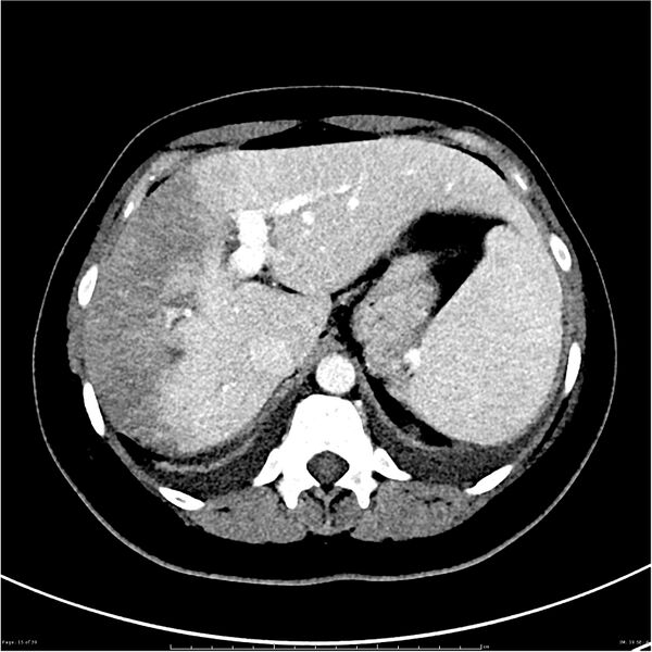 File:Budd-Chiari syndrome (Radiopaedia 27929-28177 Axial liver window 15).JPG