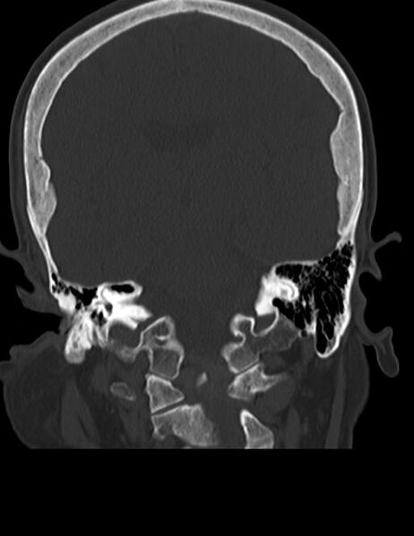 File:Burnt-out meningioma (Radiopaedia 51557-57337 Coronal bone window 31).jpg