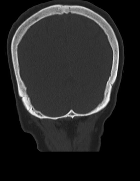 File:Burnt-out meningioma (Radiopaedia 51557-57337 Coronal bone window 45).jpg
