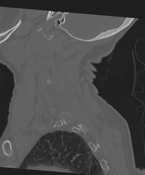 File:C2 fracture with vertebral artery dissection (Radiopaedia 37378-39199 Sagittal bone window 18).png
