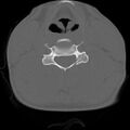 C5 facet fracture (Radiopaedia 58374-65499 Axial bone window 51).jpg
