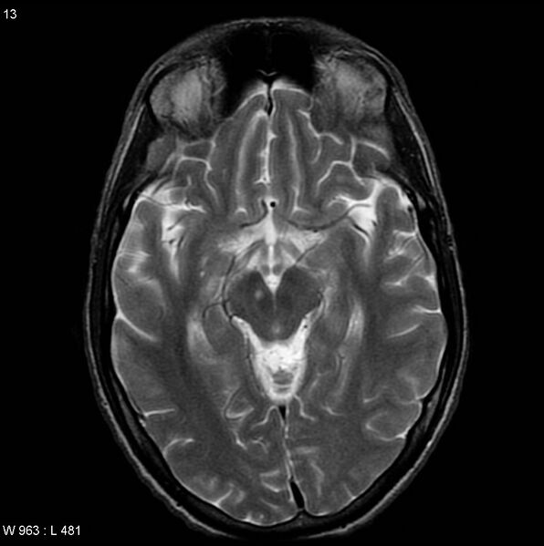 File:CMV ventriculitis and encephalitis (Radiopaedia 5416-7166 T2 2).jpg