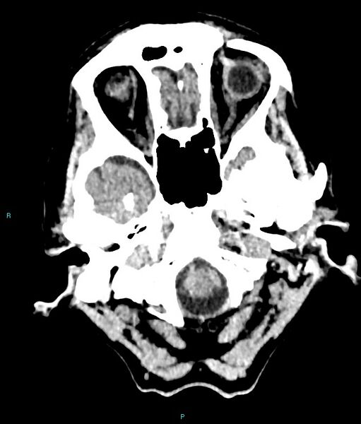 File:Calcified cerebral emboli from left ventricular thrombus (Radiopaedia 84420-99758 Axial non-contrast 80).jpg