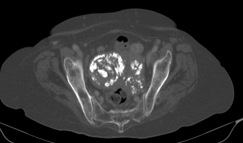 File:Calcified fibroids (Radiopaedia 20306-20228 Axial bone window 17).jpg