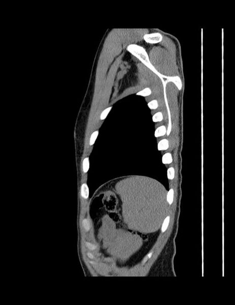 File:Calcifying pulmonary metastases (Radiopaedia 33359-34396 C 8).jpg