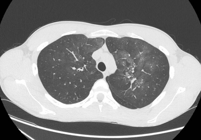 File:Cannabis-induced diffuse alveolar hemorrhage (Radiopaedia 89834-106946 Axial lung window 31).jpg