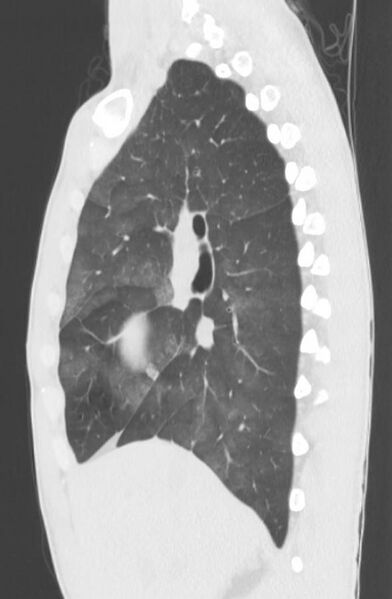File:Cannabis-induced diffuse alveolar hemorrhage (Radiopaedia 89834-106946 Sagittal lung window 53).jpg