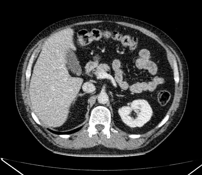 File:Carcinoid tumor with hepatic metastases (Radiopaedia 22651-22670 C 41).jpg