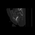 Carcinoma cervix- brachytherapy applicator (Radiopaedia 33135-34173 Sagittal bone window 112).jpg