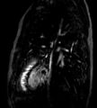 Cardiac hemangioma (Radiopaedia 16971-64065 Multiplanar 5).JPG