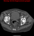 Cardiac perforation following transcatheter aortic valve implantation (Radiopaedia 23714-23863 B 3).png