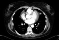 Cardiac sarcoidosis (Radiopaedia 74548-85534 A 49).jpg