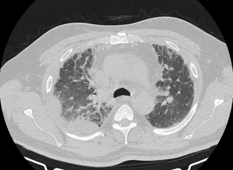 File:Cardiogenic pulmonary edema (Radiopaedia 68180-77678 Axial lung window 28).jpg