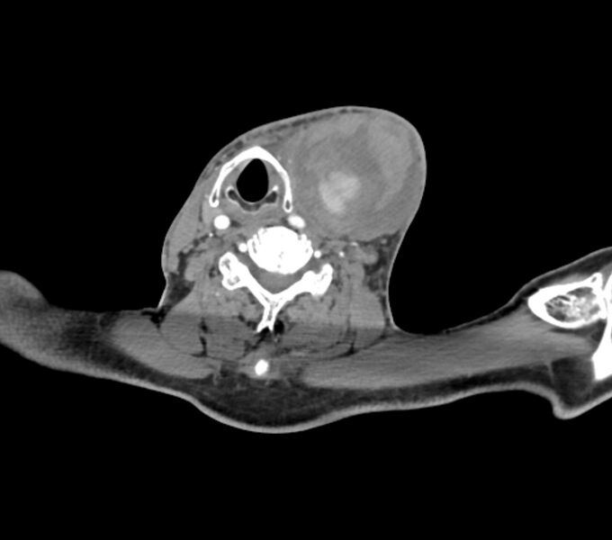 File:Carotid artery pseudoaneurysm (Radiopaedia 84030-99259 C 54).jpg