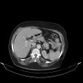 Carotid body tumor (Radiopaedia 21021-20948 A 56).jpg
