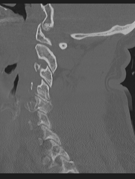 File:Cavernoma of cervical cord (Radiopaedia 50838-56346 Sagittal bone window 31).png