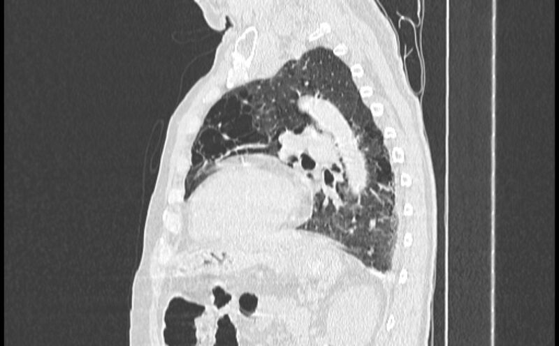 File:Cavitating bronchogenic carcinoma (Radiopaedia 44489-48162 Sagittal lung window 43).jpg