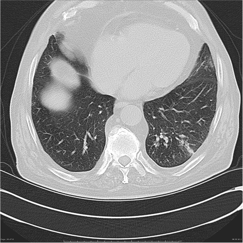 Cavitating left lower lobe lesion - squamous cell lung cancer (Radiopaedia 27749-28176 Axial lung window 38).jpg