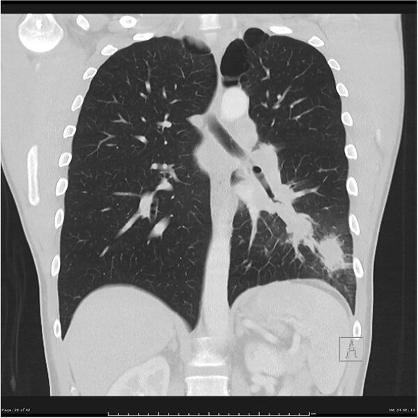 File:Cavitating lung cancer (Radiopaedia 25796-25945 lung window 26).jpg