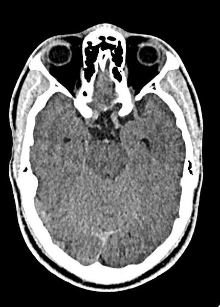 File:Cavum septum pellucidum and cavum vergae (Radiopaedia 77797-90060 Axial Brain Window 38).jpg