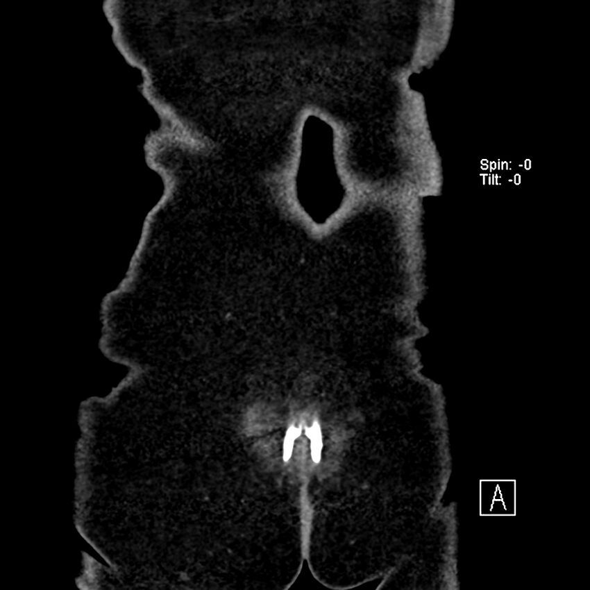 Cecal volvulus (Radiopaedia 90897-108397 Coronal non-contrast 1).jpg