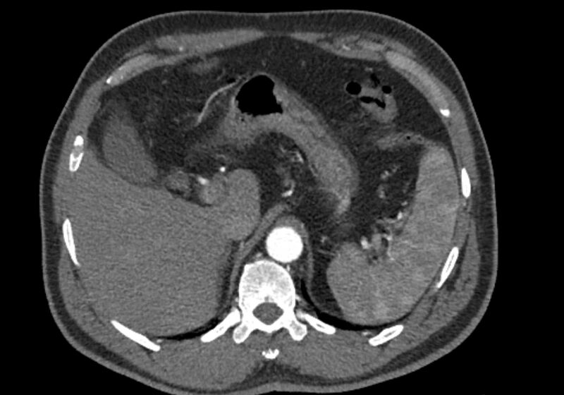 File:Celiac artery dissection (Radiopaedia 52194-58080 A 18).jpg