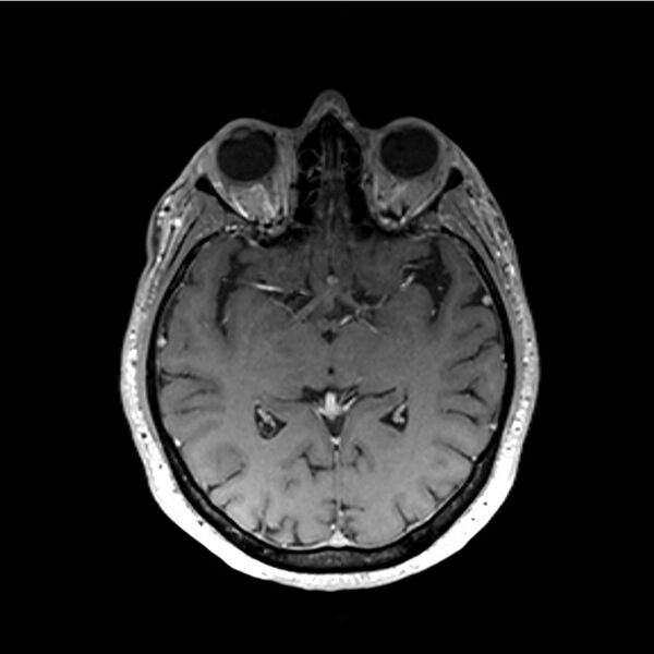 File:Central base of skull meningioma (Radiopaedia 53531-59549 Axial T1 C+ 29).jpg