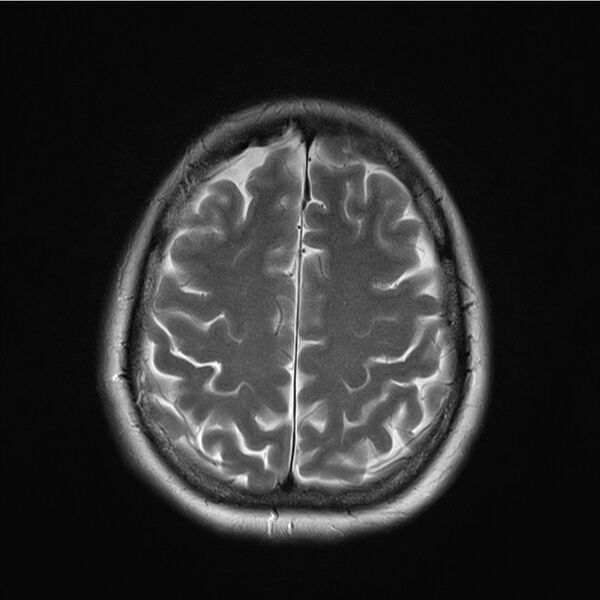 File:Central base of skull meningioma (Radiopaedia 53531-59549 Axial T2 16).jpg