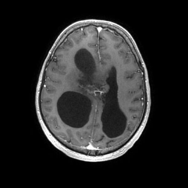 File:Central neurocytoma (Radiopaedia 67618-77021 Axial T1 C+ 20).jpg