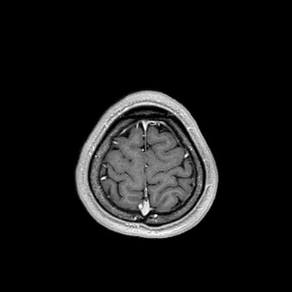 File:Central neurocytoma (Radiopaedia 79320-92380 Axial T1 C+ 208).jpg