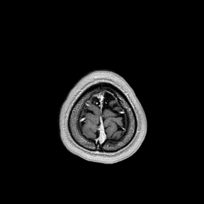 Central neurocytoma (Radiopaedia 79320-92380 Axial T1 C+ 216).jpg