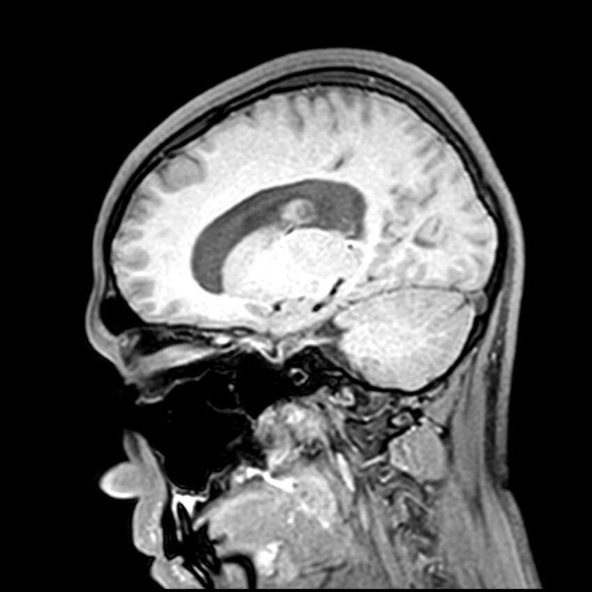 Central neurocytoma (Radiopaedia 79320-92380 Sagittal T1 102).jpg
