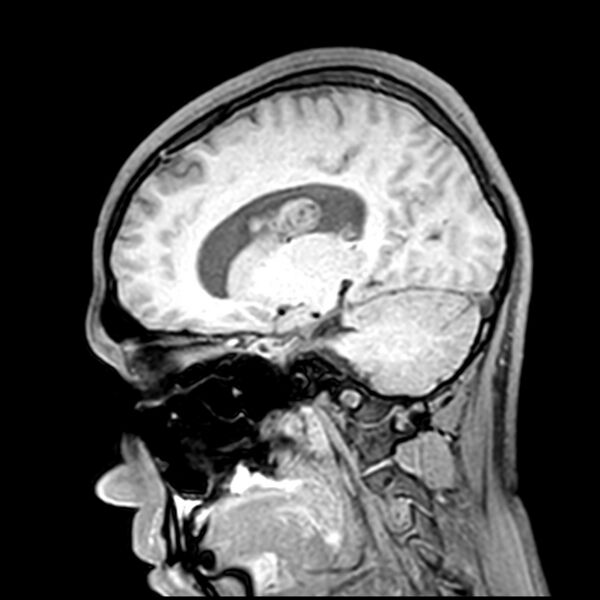File:Central neurocytoma (Radiopaedia 79320-92380 Sagittal T1 105).jpg